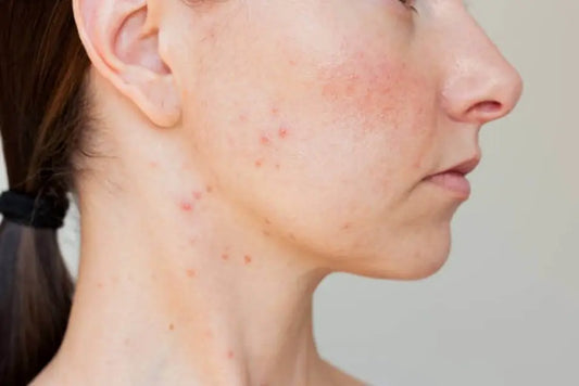 Ivermectin for Rosacea: Benefits, Dosing & What to Expect