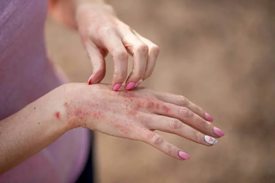 Psoriasis vs Eczema: Symptoms, Causes, and Treatment Differences
