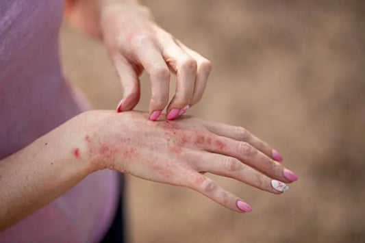 Psoriasis vs Eczema: Symptoms, Causes, and Treatment Differences