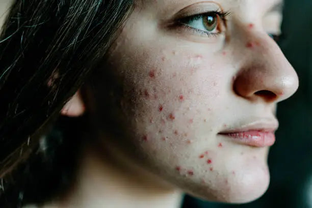 How Rosacea Compounding Can Help Manage Skin Flare-ups