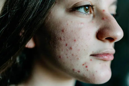 How Rosacea Compounding Can Help Manage Skin Flare-ups